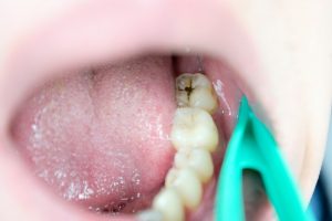 ząb z próchnicą